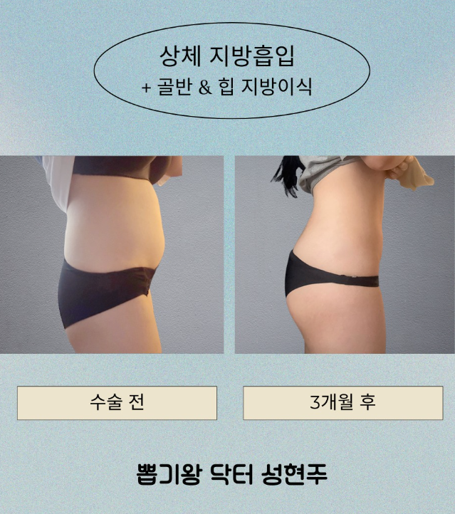 압구정복부지방흡입, 살을 빼도 아랫배만 남는 이유는 따로 있습니다 관련 이미지 3