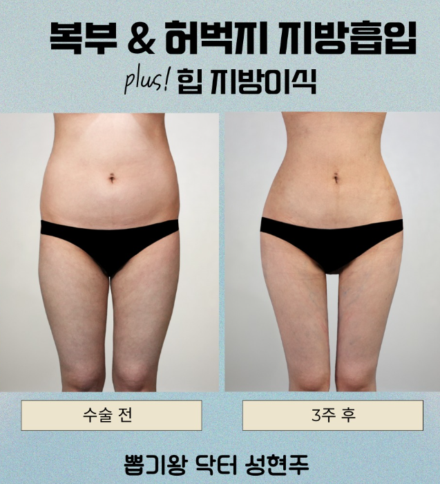 압구정복부지방흡입, 살을 빼도 아랫배만 남는 이유는 따로 있습니다 관련 이미지 7