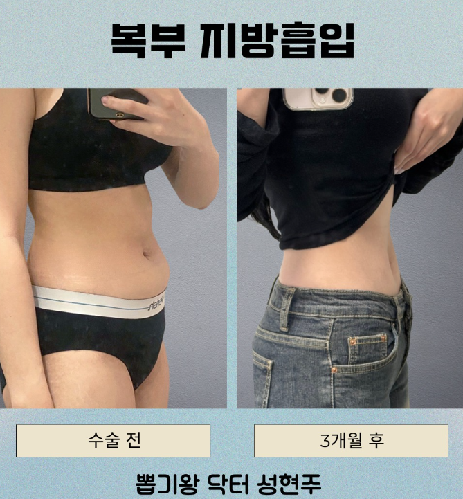압구정복부지방흡입, 살을 빼도 아랫배만 남는 이유는 따로 있습니다 관련 이미지 5