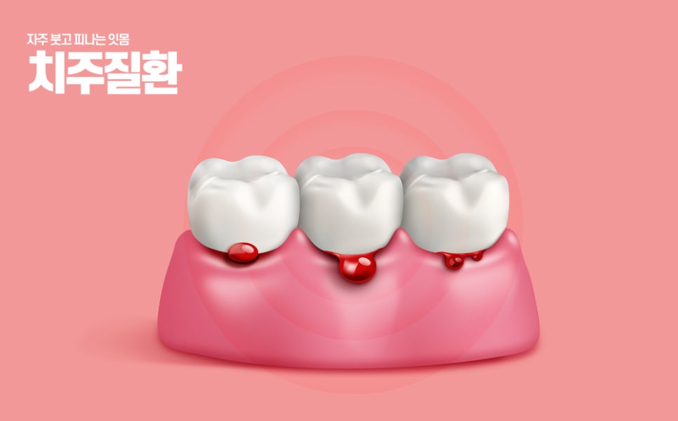 양촌치과 잇몸치료 아프지 않지만 필요한 이유는