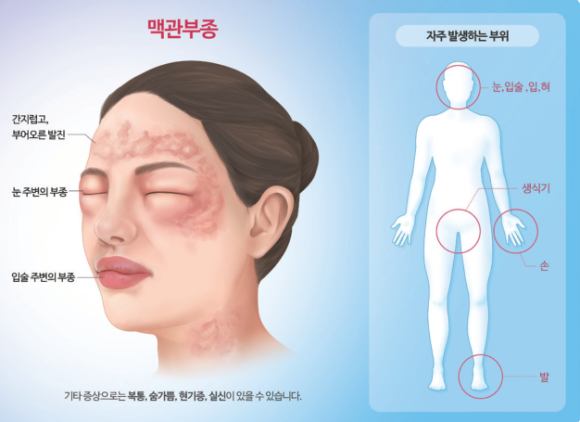 익산바른몸한의원 블로그 본문 이미지