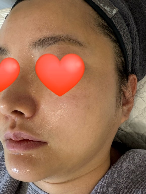 🏷️휴무기록,양산 여드름살롱 압출 잘하는 곳, 붉은기 진정까지 완벽