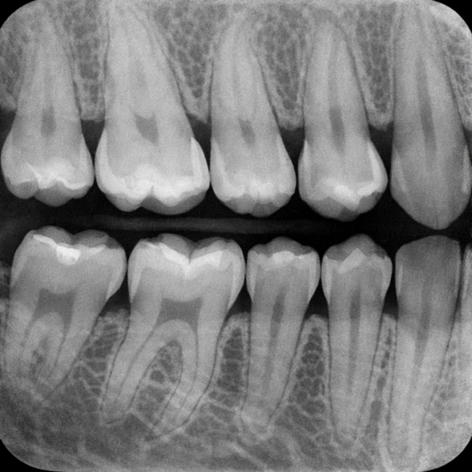 강서 치과 에서 알아보는 치아 사이 인접면 충치의 위험성 (ft. 정기검진의 중요성) 관련 이미지 5
