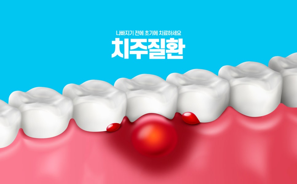 장기동치과 잇몸이 붓는 이유는 무엇일까요?