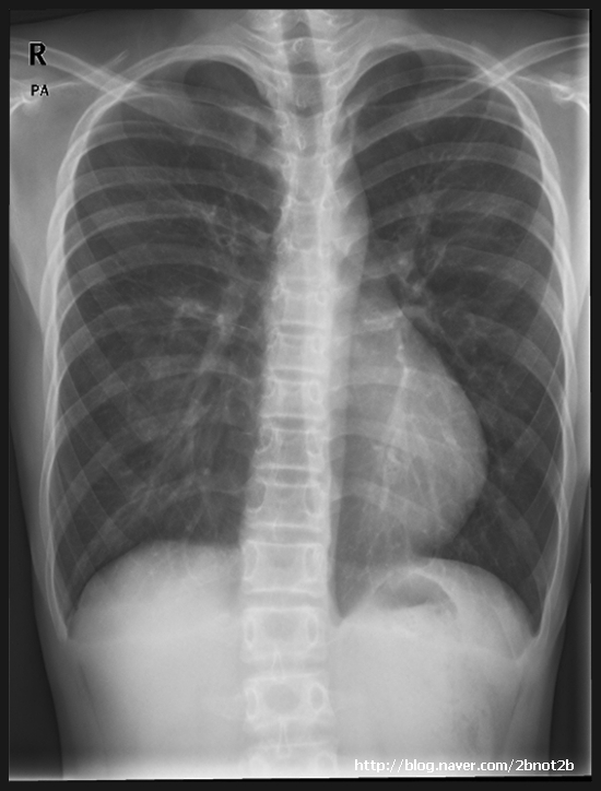 누두흉(오목가슴) (funnel chest, pectus excavatum) 네이버 블로그