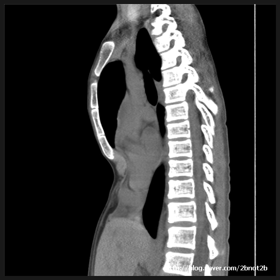 누두흉(오목가슴) (funnel chest, pectus excavatum) 네이버 블로그