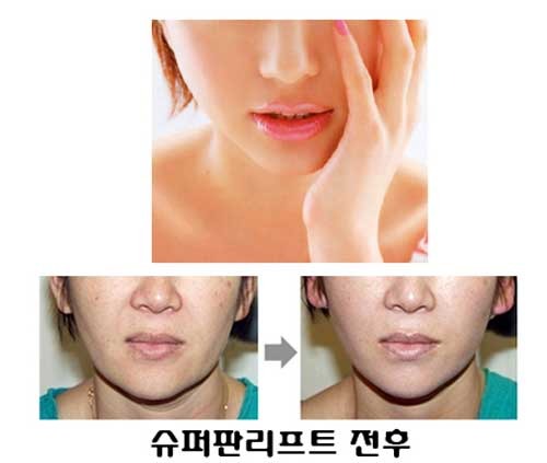 V라인S라인 이미지
